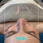 institut & spa éveil des sens oudon - institut de beauté spa JETPEEL ANTI RIDES alternative botox - 25.10.2023